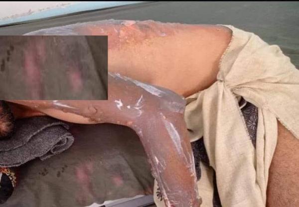 إصابة شخص جراء اندلاع حريق في مخيم للنازحين في مأرب
