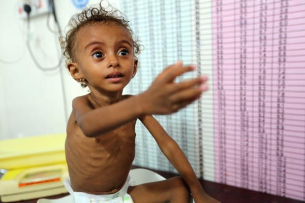 الصحة العالمية: سوء التغذية يبلغ مستويات قياسية في اليمن هذا العام