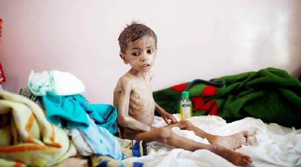 تحذيرات أممية: 400 ألف طفل يمني مهددون بالموت و5 ملايين نسمة على بُعد خطوة من المجاعة