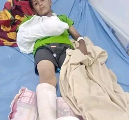 إصابة طفلين بانفجار مقذوف حوثي في حجر بالضالع