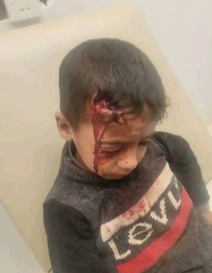 وفاة طفل في إب بعد 15 يوماً من تعرضه لعضة كلب ضال