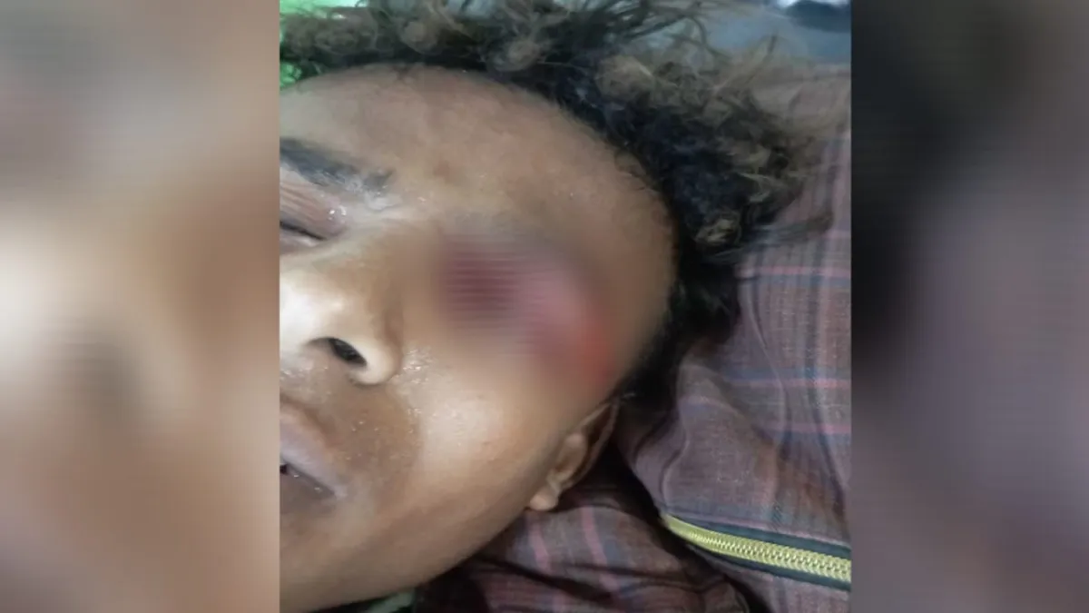 إصابة شاب في عينه بسبب ألعاب نارية عشية عيد الفطر في الحديدة