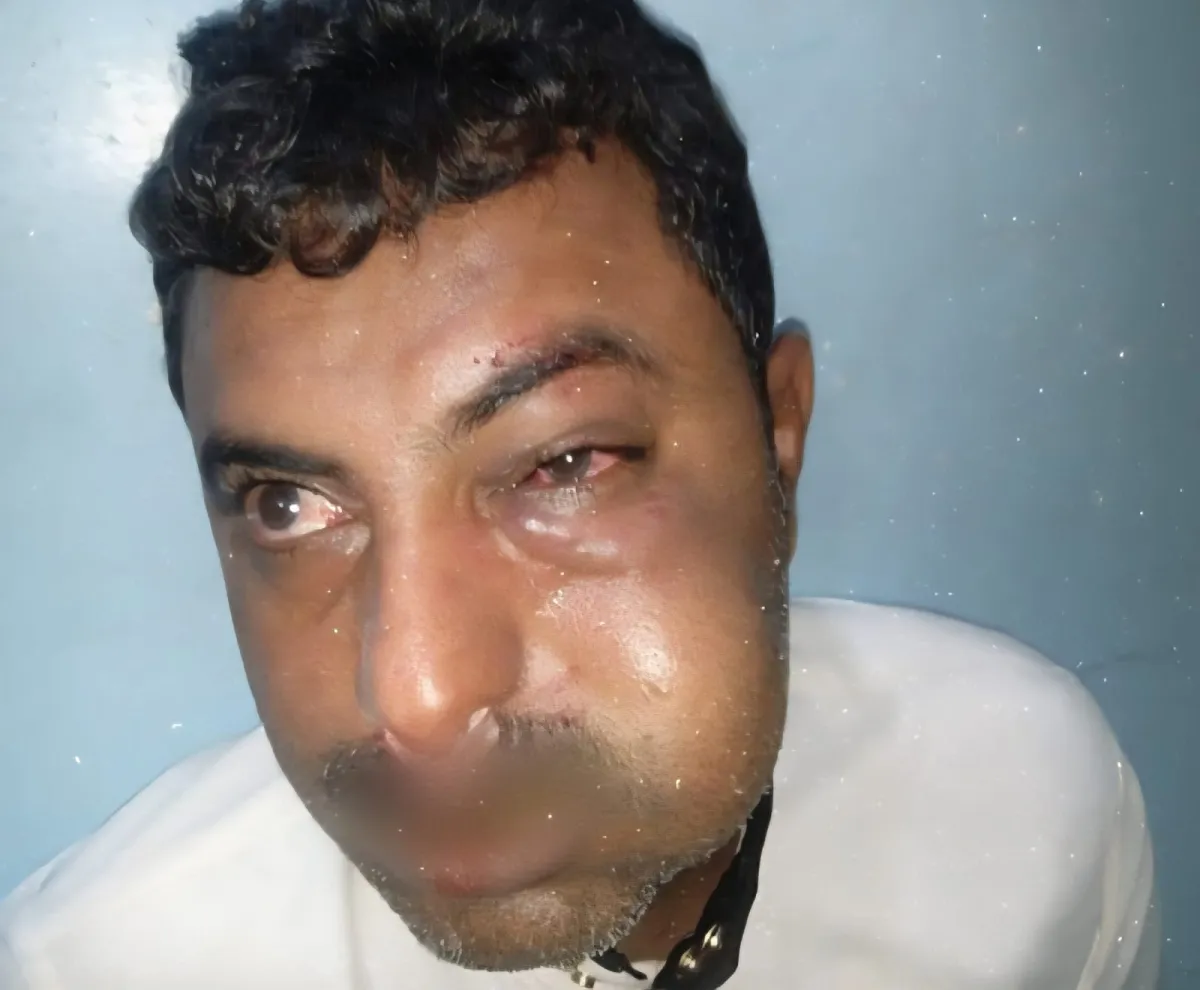 قيادي حوثي يعتدي بالضرب على محامٍ في مدينة زبيد بالحديدة