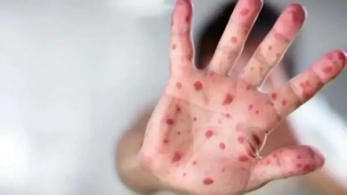 Measles Outbreak in Marib: 1,500 Cases, 10 Deaths This Year